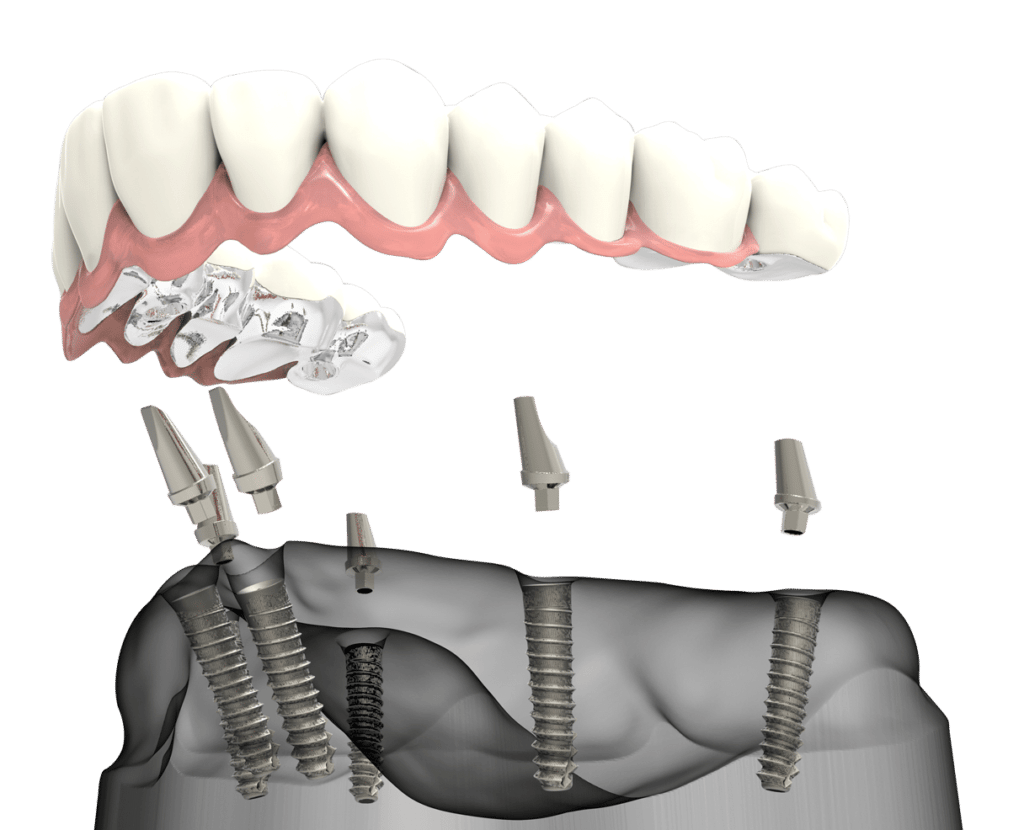 Full arch digital design - dentist in Bridgeville, PA