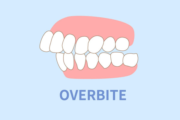 overbite illustration